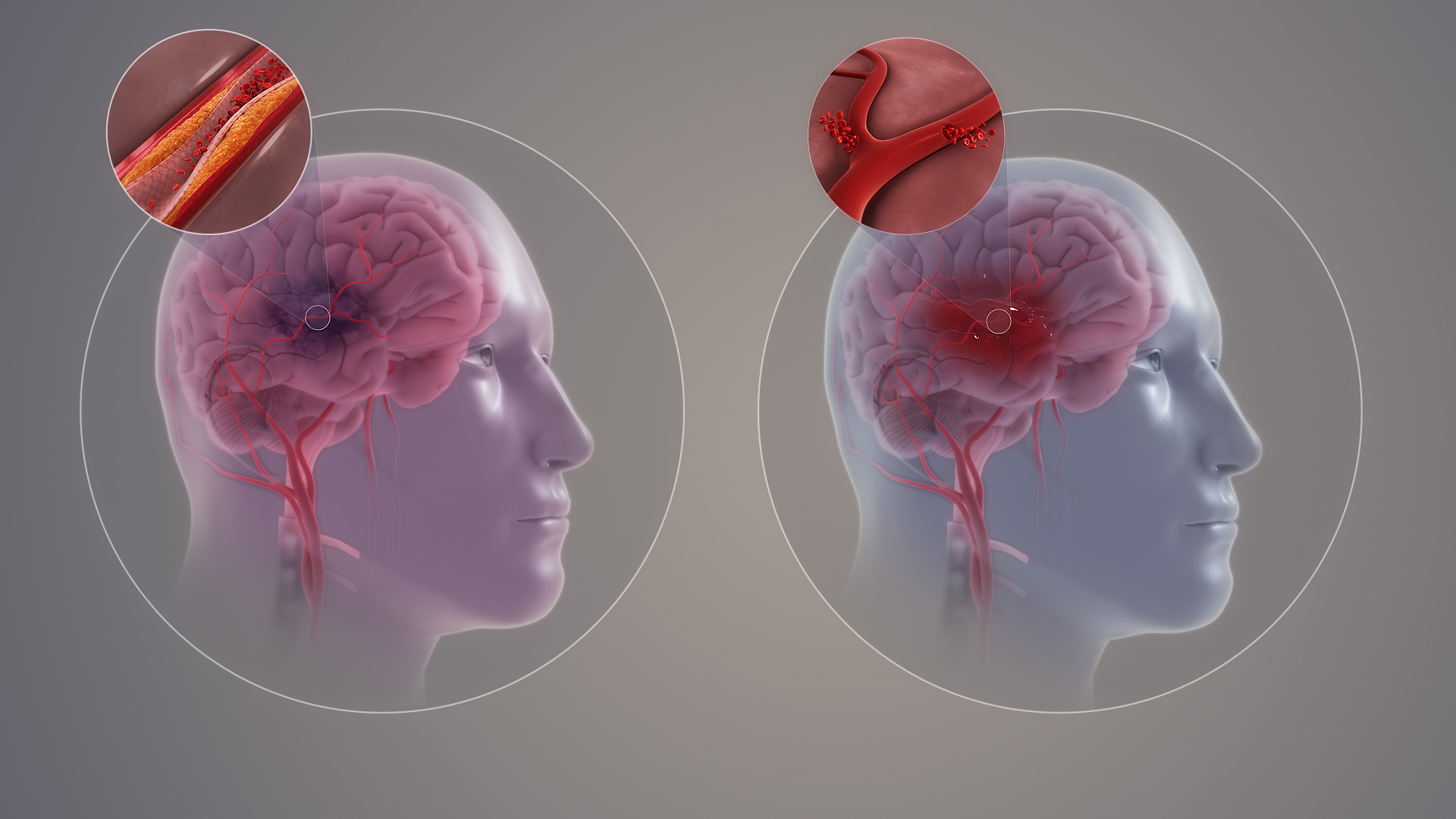 Neuralert: New Stroke Detection Device May Save Lives - Vanderbilt Vanguard